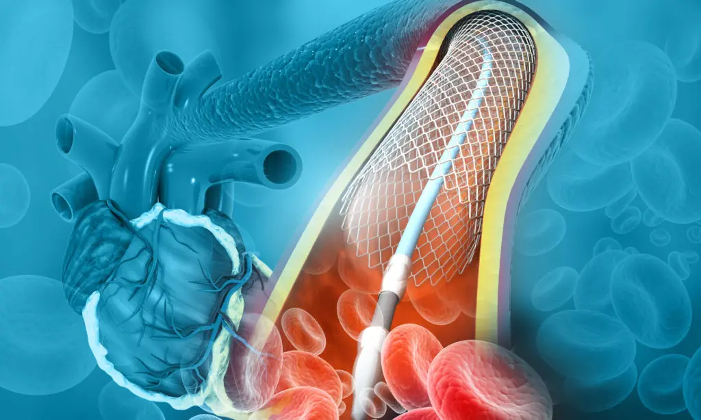 Angina Treatment